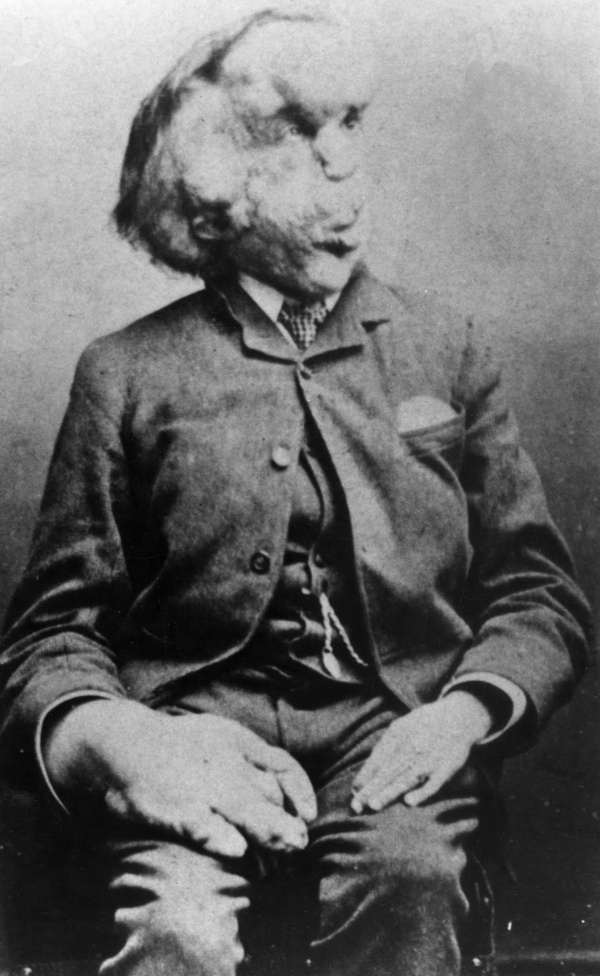 "The Elephant Man" John Merrick